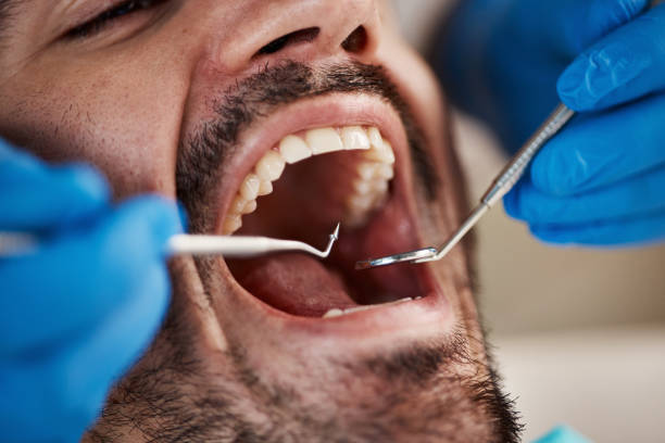 Best Emergency Tooth Extraction in Bellevue, IA